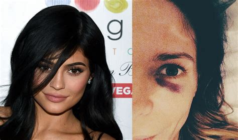 Kylie Jenners Black Eye Has People Asking Questions Iheart