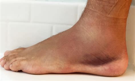 What I Learned Treating My Own Ankle Sprain