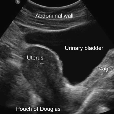 Transabdominal Ultrasound Of The Uterus Download Scientific Diagram