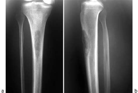 A Anteroposterior Radiograph Of The Proximal Tibia Shows A