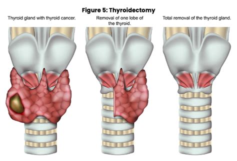 Thyroid Dysfunction Nursing CE Course NursingCE