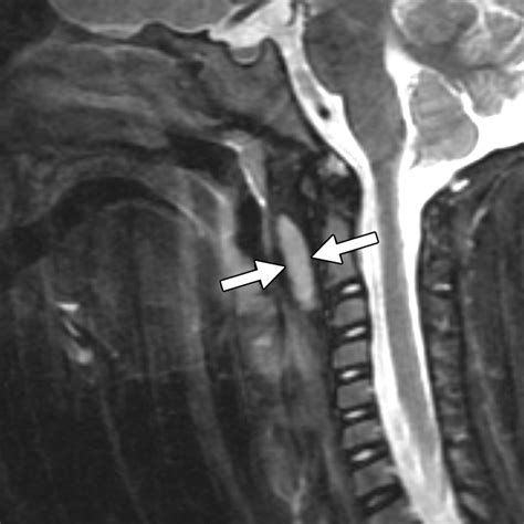 Retropharyngeal Lymph Nodes In Children A Common Imaging Finding And