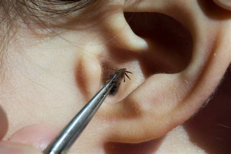 Bug In Ear Signs Symptoms Removal And Complications