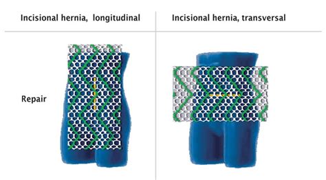 Dynamesh Cicat Surgical Mesh Implants Hernias Kebomed