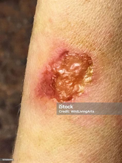 Ringworm Fungus Skin Infection On Human Arm Stock Photo Download