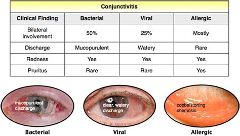 Conjunctivitis Reeldx Lecture Smarty Pance