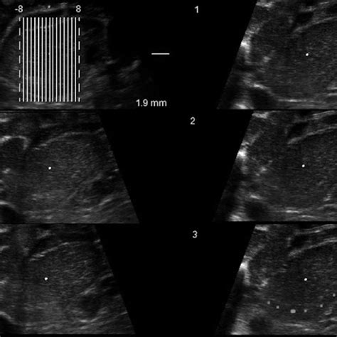 Tui Tomographic Ultrasound Imaging Longitudinal Section Of A Female
