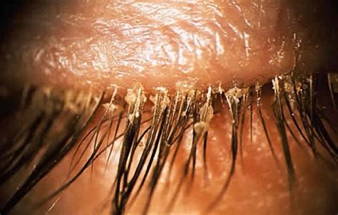Demodex Infestation Of The Eyelashes Coral Springs Eye Doctor