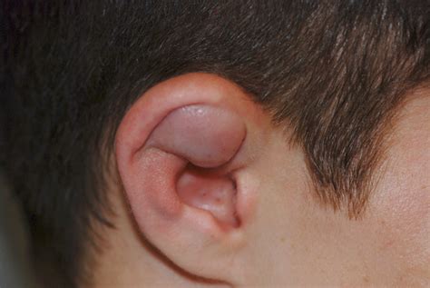 Boxers Ear Can Your Ear Explode What Is Auricular Hematoma Or
