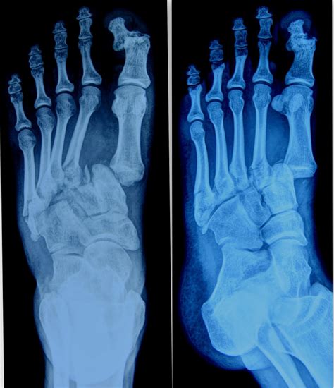 Dislocation The Foot And Ankle Online Journal