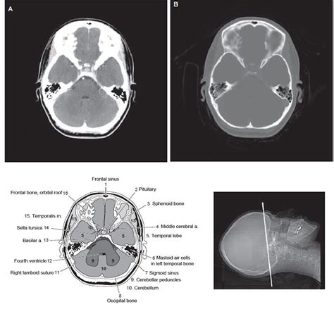 Head Ct Scan Procedure Radtechonduty Ct Scan Brain Anatomy