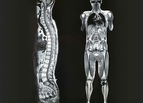 Whole Body Mri For Identifying Metastatic Disease In Colorectal Cancer
