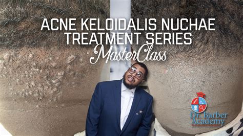 AKN Acne Keloidalis Nuchae Treatment MasterClass Doctor Barber Chicago