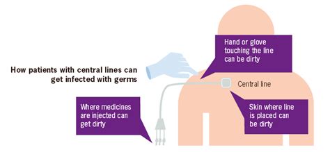 Preventing Central Line Infections My Doctor Online