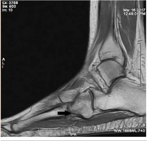 Figure 1 From Not All Ankle Injuries Are Ankle Sprains Case Of An