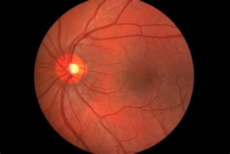 Why Do Doctors Dilate My Eyes? A Retinal Picture's Worth a Thousand ...