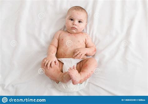 Upset Newborn Baby Suffering From Measles Rash Stock Photo Image Of