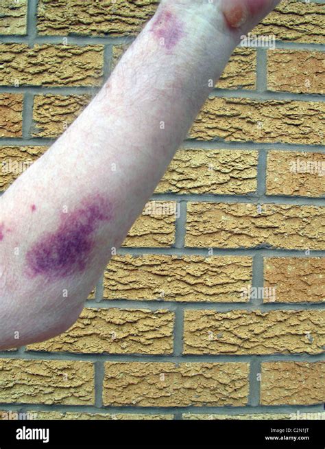 Detail Bruised Arm Hi Res Stock Photography And Images Alamy