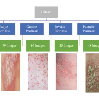 PDF Deep Learning Application For Effective Classification Of Different Types Of Psoriasis