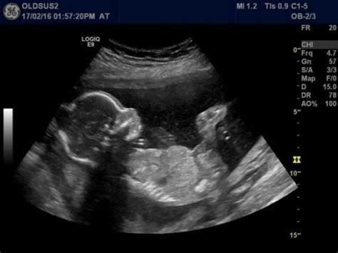 Gender Guess 20 Week Ultrasound July 2016 Babycenter