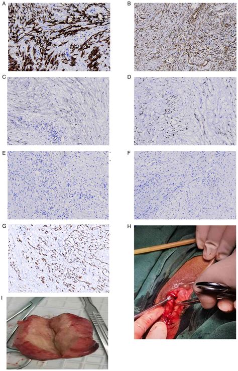 Vaginal Leiomyoma A Case Report