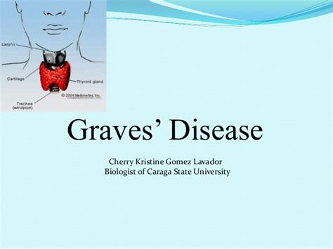 Graves Disease An Autoimmune Disease