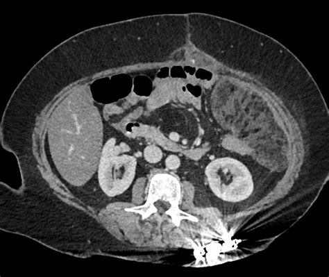 Omental Infarction Left Upper Quadrant Following Distal Pancreatectomy