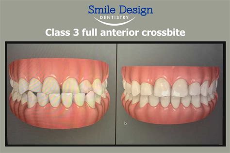 Fixing A Class 3 Full Anterior Crossbite Smile Design Dentistry