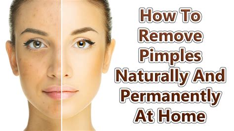 Definitely do not use regular acne cleansers for cystic acne because the drying effect can make inflammation worse. How To Remove Pimples Naturally And Permanently At Home ...
