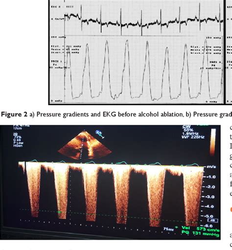 Figure 3 From Alcohol Septal Ablation In Hypertrophic Obstructive