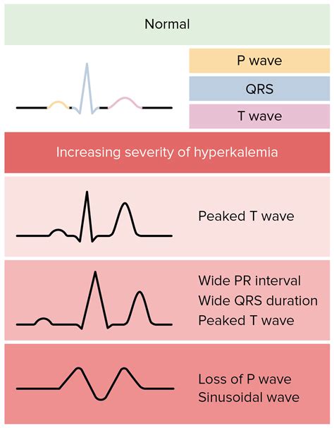 Hyperkalemia Clinical Concise Medical Knowledge