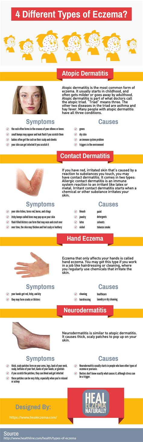 This Infographic Was Created By Heal Eczema Naturally The Most Common