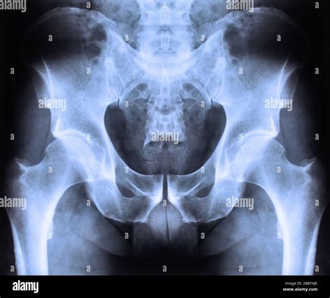 Human Abdomen Xray Hi Res Stock Photography And Images Alamy