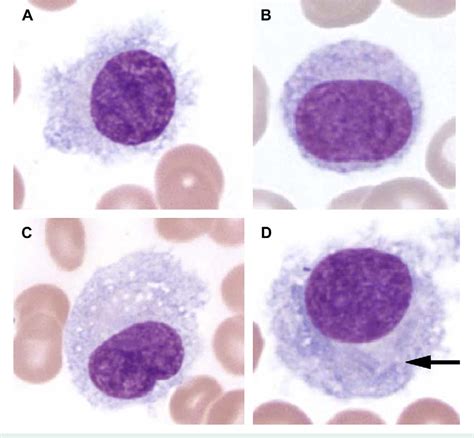 Figure 1 From Of North America Hairy Cell Leukemia
