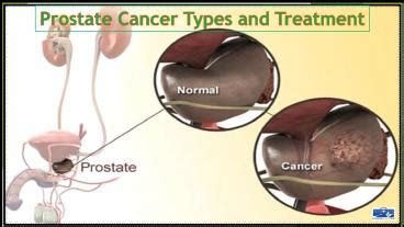 Ppt Prostate Cancer Symptoms Types And Treatment Powerpoint Presentation Free To Download