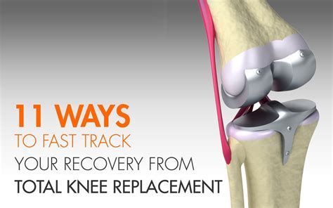 11 Fast Recovery Tips From Total Knee Replacement • Copperjoint