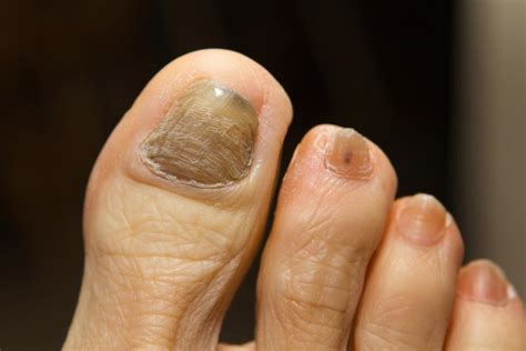 Thick Toenails Causes Symptoms And Treatments