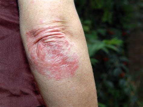 What Is Plaque Psoriasis Symptoms Treatments And More Self