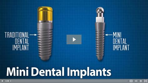 What Is The Difference Between Mini Dental Implants And Regular