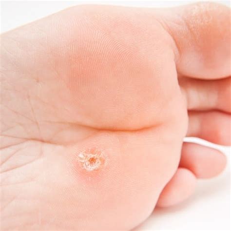 Warts And All What You Need To Know About Common Warts Central Texas