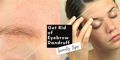 Eyebrow Dandruff Is Totally A Thing Heres How To Treat It According