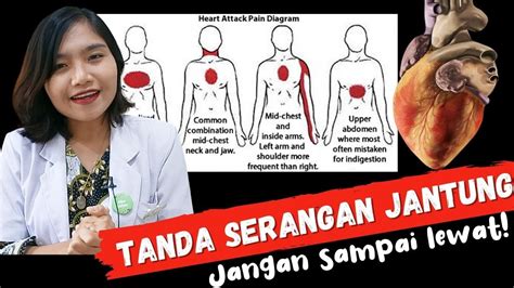 Gejala Awal Sakit Jantung Homecare24