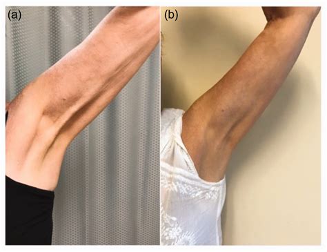 Axillary Web Syndrome Following Collagenase Injection For Dupuytrens