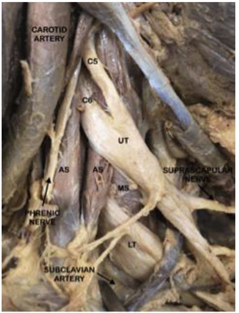 Anatomical Variation Of The Brachial Plexus And Its Clinical
