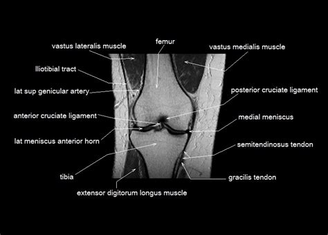 Anatomy of the knee is complex, through the use of magnetic resonance imaging, clinicians can diagnose ligament and meniscal injuries along with identifying cartilage defects, bone fractures and bruises. knee anatomy | MRI knee coronal anatomy | free cross sectional anatomy