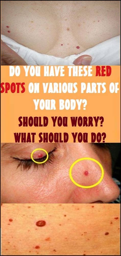 Do You Have These Red Spots On Various Parts Of Your Body Should You