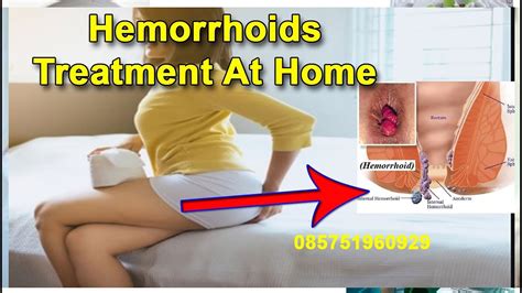Hemorrhoids Treatment At Home Youtube