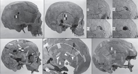 2 Top Row Examples Of Entrance And Exit Gunshot Wounds Scored In The