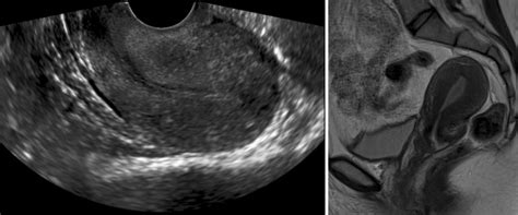 Example Of A False Negative Ultrasound For Adenomyosis Using Mri As The