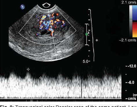 Figure 8 From Ultrasound Imaging Of Gestational Trophoblastic Disease